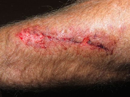Unexpected Helpers in Wound Healing