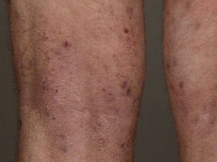 New Potential Approach to Treat Atopic Dermatitis