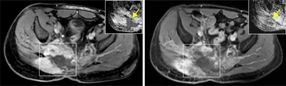 Targeted approach to therapy for rare type of bone cancer