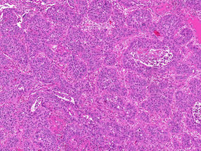 Machine learning improves cancer diagnosis