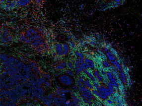 Refining Breast Cancer Classification by Multiplexed Imaging