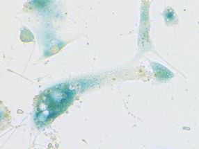 COVID-19: What is driving the escalating hyperinflammation