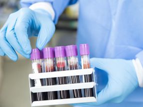 Cancer DNA in the blood: an early warning system for recurrent tumors in children