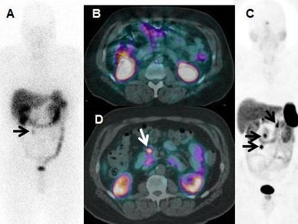 A better way to diagnose and manage neuroendocrine tumors