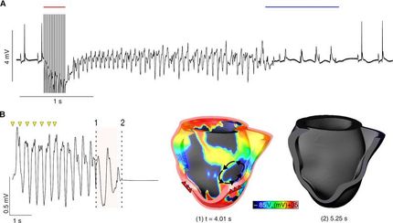 Termination of lethal arrhythmia with light
