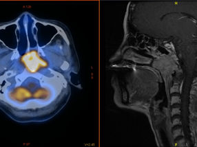 Covid vaccination improves effectiveness of cancer treatment