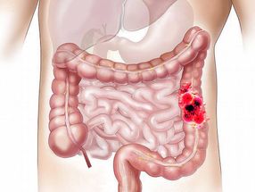 Dying cancer cells give neighbouring tumour cells instructions on how to survive