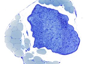 Fat cells help repair damaged nerves