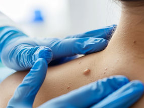 The Mechanism Behind Melanoma Resistance to Treatment