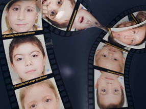Rare genetic diseases can sometimes be recognized by the face