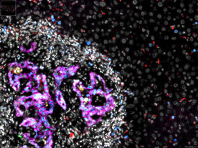 Preventing cancer cells from colonising the liver