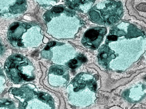 New target to treat severe autoimmune disease
