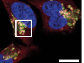 New mechanism: How cancer cells escape the immune system