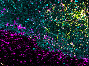 New treatment attacks brain tumors from multiple angles