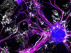 Inflammatory messenger fuels Alzheimer’s