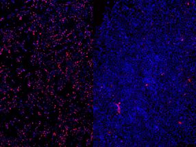 Antisense RNA for the treatment of severe epilepsy in premature infants