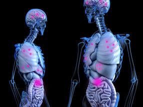 Colorectal cancer: Genetic changes control metastasis formation